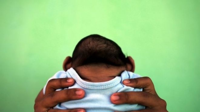 Spain registers first Zika microcephaly birth in Europe