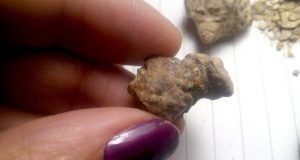 Study links first kidney stone event with chronic kidney disease