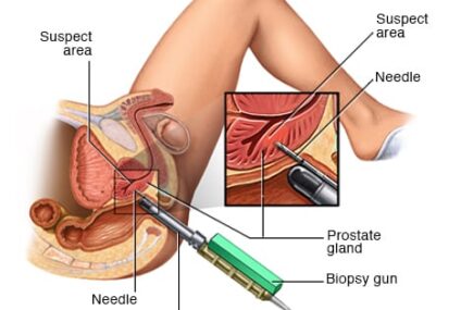 How is PSA used to monitor prostate cancer?