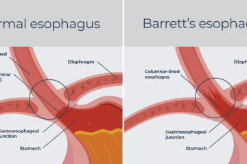 What You Need to Know About Barrett’s Disease