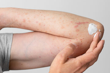 Fungal Infections: Symptoms, Causes & Effective Treatment Options