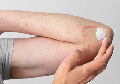 Fungal Infections: Symptoms, Causes & Effective Treatment Options