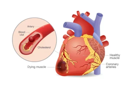 Diabetes and Your Heart: How Blood Sugar Impacts Your Arteries